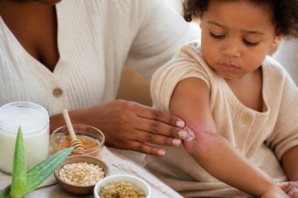 How to Treat Eczema in Children Naturally: A Parent's Guide
